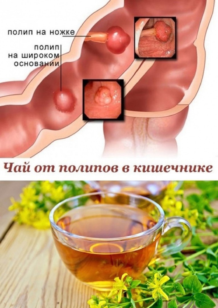 Чай от полипов кишечника