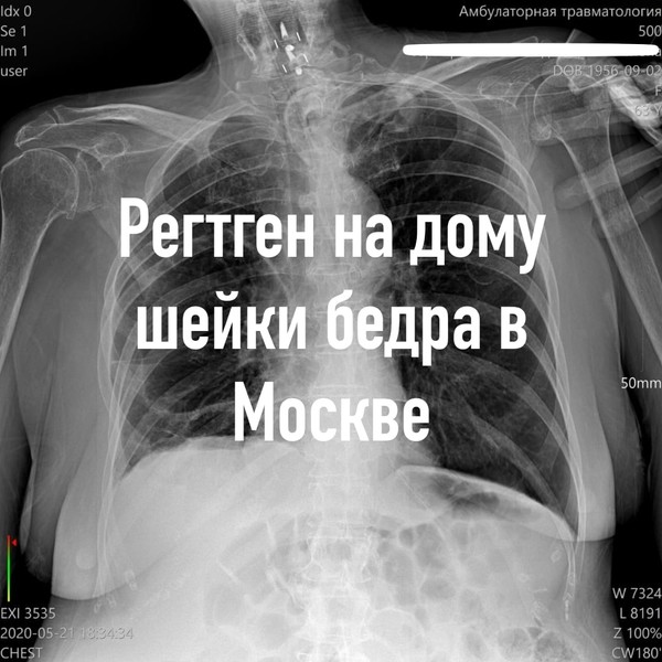 Уже давно и множество раз доказано, что курение и употребление алкоголя отрицательно сказываются на здоровье. Вредные привычки ухудшают работу почек, ведь те не в силах справляться с большим количеством поступивших в организм токсических веществ. Это только в кино все красиво курят и попивают, а в жизни на самом деле — медленно убивают себя. Задумайся над этим в тот момент, когда будешь доставать очередную сигаретку или бутылочку пива…
#рентген_в_москве, #рентген_легких, #перелом_шейки_бедра, #шейка_бедра, #сделать_рентген, #сделать_рентген_на_дому, #вызвать_врача, #вызвать_врача_на_дом, #врач_на_дом, #вызвать_травматолога, #травматолог_на_дом, #перелом_ребер, #вправить_вывих, #травматолог, #перелом, #травма #вывих, #флюорография, #флюорография_на_дому, #ушиб, #пневмония #функциональная_кровать #рама_балканского
#рентгеннадому #рентгеннадомуМосква
#Рама_Балканского
#травматолог_на_дом_Москва
#рентген_на_дому_шейки_бедра_Москва
#рентген_на_дому_лёгкие_Москва
#рентген_на_дому_позвоночника_Москва
#рентген_на_дому_отзывы_Москва
#сделать_рентген_на_дому_Москва
#вызвать_рентген_на_дом_Москва
#рентген_на_дому_тазобедренного_сустав
#Московский_рентген_Рентген_на_дому_шейки_бедра
РЕНТГЕН НА ДОМУ - в Москва при переломе шейки бедра и пневмонии Рентген на дому Москва : по вашему адресу приезжает врач-рентгенолог, травматолог-ортопед с мобильным рентгеновским аппаратом, проводит диагностику травмы или заболевания, делает необходимые рентгенограммы, проявляет их на месте, дает рекомендации по дальнейшему лечению. Рентген на дом бесплатно по полису ДМС добровольное медицинское страхование , круглосуточная помощь нуждающимся, круглосуточно, Москва и Московская область, наш адрес: Москва , Пречистенский бульвар, дом 18; 8-903-777-00-17 , 24/7 ; ОБЛАСТИ(Подмосковье): Балашиха Реутов Новокосино Москва Мытищи Пушкино Королёв Фрязино Ивантеевка Долгопрудный Химки Лобня Красногорск Истра Одинцово Троицк Подольск Щербинка Развилка Видное Домодедово Внуково Новопеределкино Дзержинский Жуковский Люберцы Раменское. круглосуточно #РЕНТГЕН_НА_ДОМУ_МОСКВА_круглосуточно "Рентген на дому Москва круглосуточно" - значит можно вызвать рентген на дому 24 часа в сутки. Выезд в ВАО Перово Гольяново Измайлово Выхино Жулебино САО Свиблово Медведково Алтуфьево Бибирево Тушино ЗАО Щукино Строгино Кунцево Крылатское Солнцево Ново-Переделкино Ясенево Коньково Бутово ЮАО Бирюлево Чертаново Царицыно Марьино Люблино Кузьминки. #РЕНТГЕН_НА_ДОМУ_МОСКВА мы не собираем личные данные, врач_ спросит только имя-отчество, соответственно, #РЕНТГЕН_НА_ДОМУ_МОСКВА_на_дому_Москва "Рентген на дому Москва" - это комплексная медицинская услуга и таблетированной седативной терапии, выполняется врачом специалистом: врач_рентгенолог_травматолог , а также рентгенолог , врачами скорой помощи, общей практики. #рентген_на_дому_выезд_на_дом_Москва "Выезд на_дом" подразумевает вызов врача-рентгенолог домой к пациенту в каждом административном округе Москвы. #вызвать_рентген_на_дом_Медведково_САО #рентген_на_дому_Алтуфьево_Алтуфьевский #рентген_на_дому_Бибирево_САО рентген_на_дом_Отрадное_САО Северный административный округ #рентген_на_дому_Строгино #рентген_на_дому_Кунцево_Кунцевская #рентген_на_дому_Тушино_Тушинская #лечение_рентген_на_дому_Митино(Куркино) ##рентген_на_дому_ЩУКИНО_ЗАО Западный административный округ #рентген_на_дом_Солнцево_ЗАО рентген_на_дом_Войковская_Сокол #вызвать_рентген_на_дом_Перово_ВАО Восточный административный #округ выезд_рентгена_на_дом_Сокольники #выездной_рентген_на_дом_МАРЬИНО #вызвать_рентген_на_дом_Люблино #выездной_рентген_на_дом_БУТОВО_Щербинка #ВЫЕЗД_РЕНТГЕН_НА_ДОМ_МОСКВА_срочно "Срочный выезд" - т.е. неотложное/быстрое прибытие доктора в течении часа после заказа услуги "рентген-травматолог на дому"(MOSCOW). #вызвать_рентген_на_дому