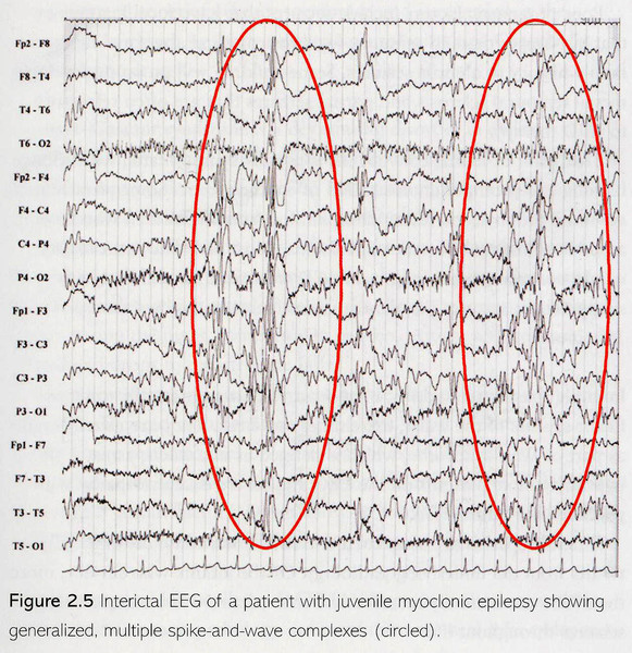 Как выглядит ээг при эпилепсии у ребенка фото